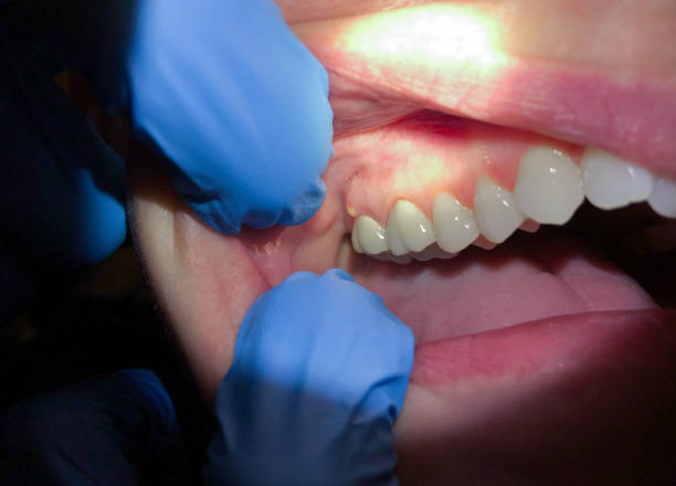 Best Dentist for Tooth Abscess  in Amerin Nyon, CA